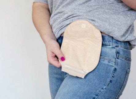 stool leaking around stoma|20 Failproof Tips To Prevent Your Stoma From Leaking